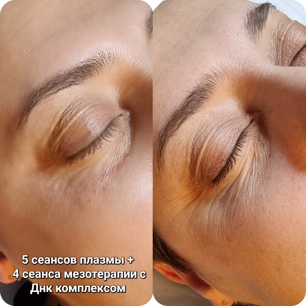 Биорепарация вокруг глаз с ПДРН Mesopharm Nucleo Spire
