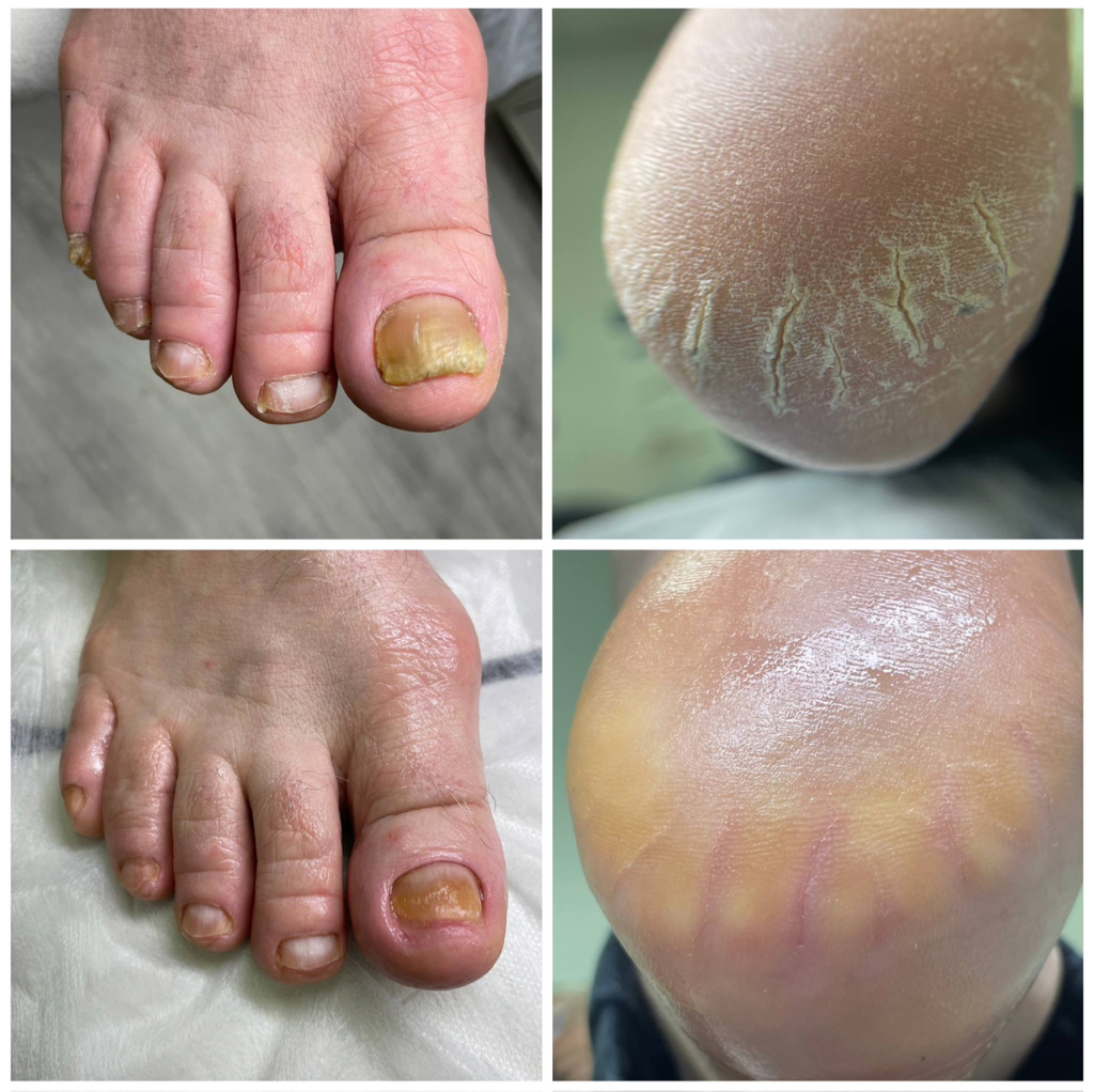 Педикюр подологический (1 степени)