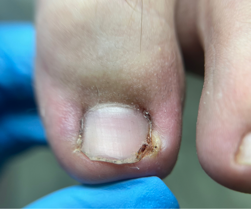 Обработка вросшего ногтя, большой палец (ПЕРВИЧНО)