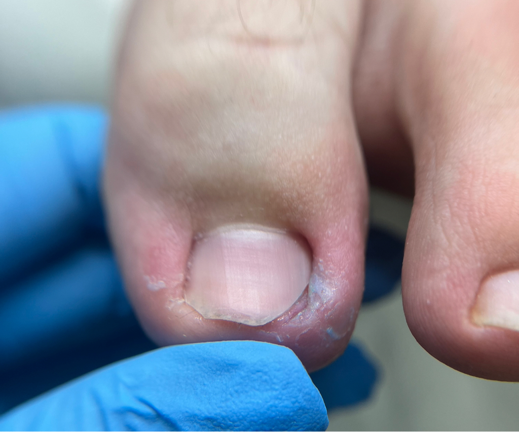 Обработка вросшего ногтя, большой палец (ПОВТОРНО)