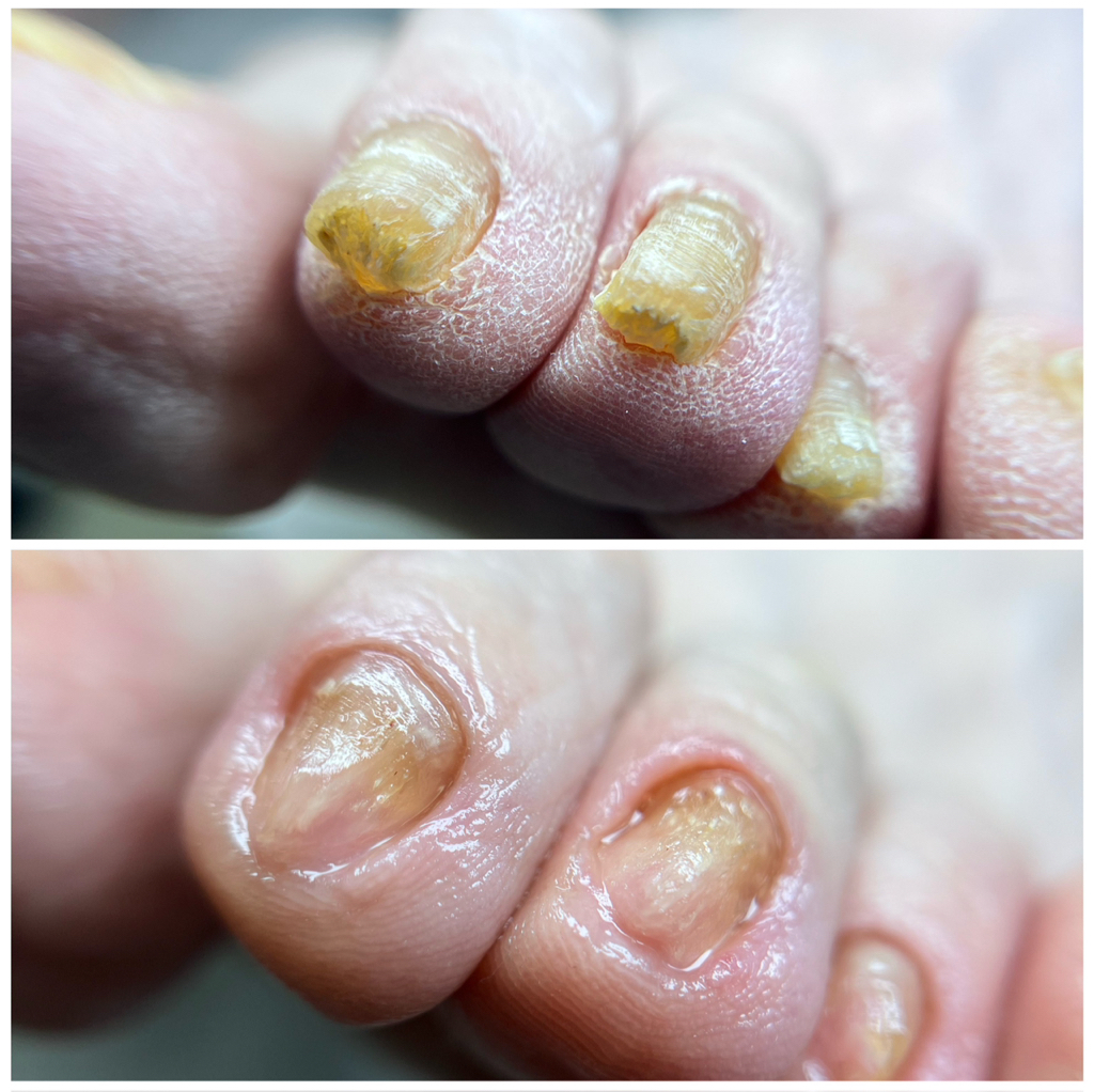 Педикюр подологический ТОЛЬКО СТОПЫ ИЛИ НОГТИ