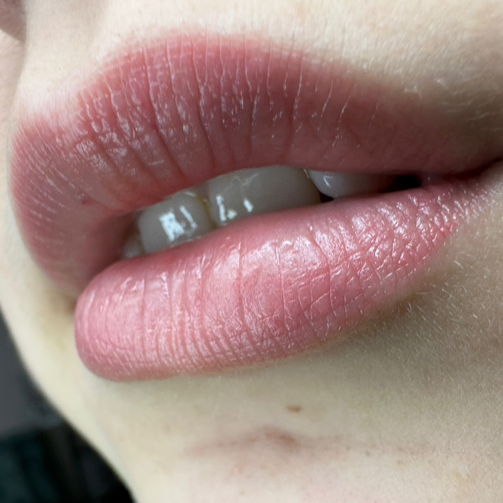 Коррекция губ пм