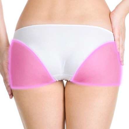 Лазерная эпиляция «Ягодицы»