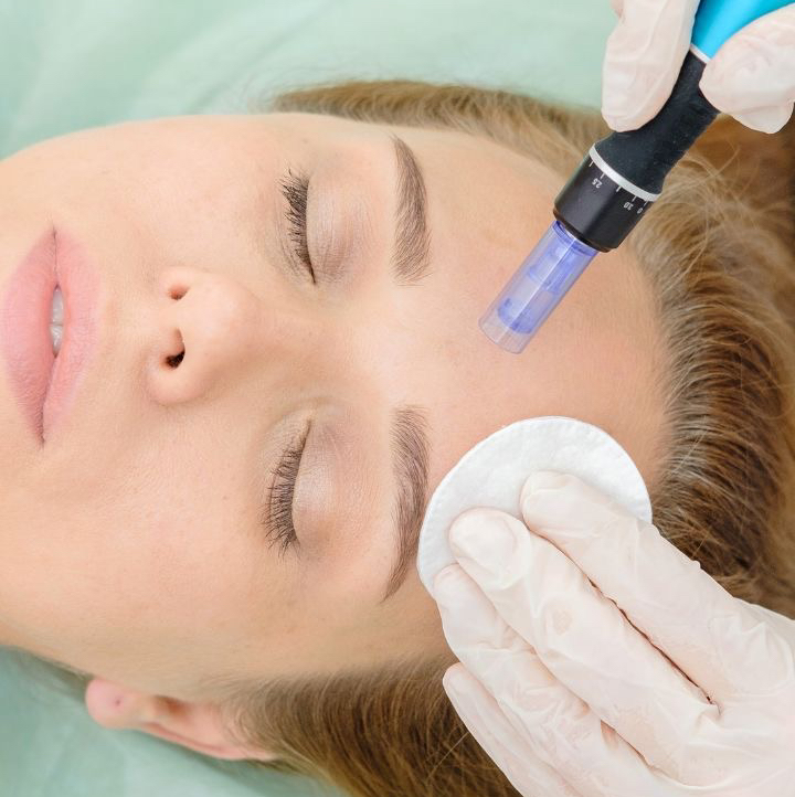 Фракционная мезотерапия