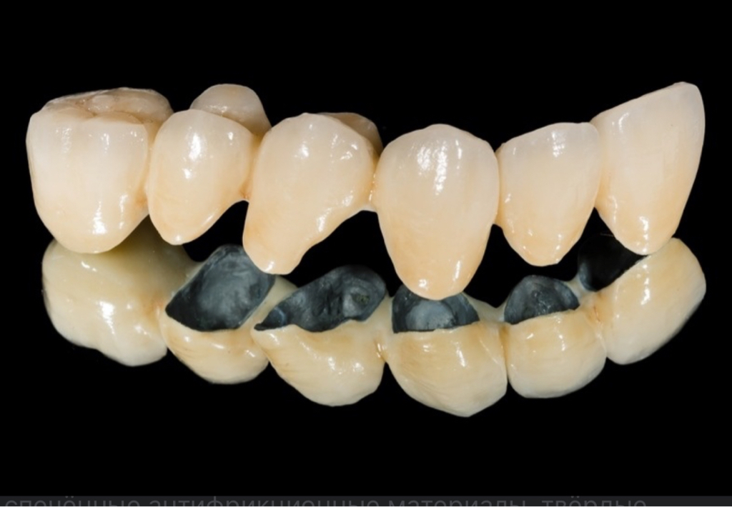 Металлокерамические коронки