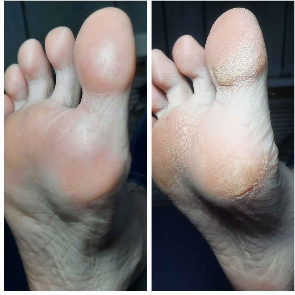 Педикюр Аппаратный