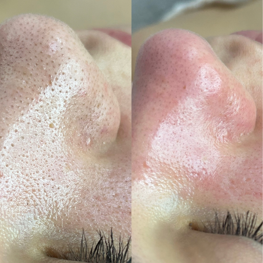 Чистка+пилинг