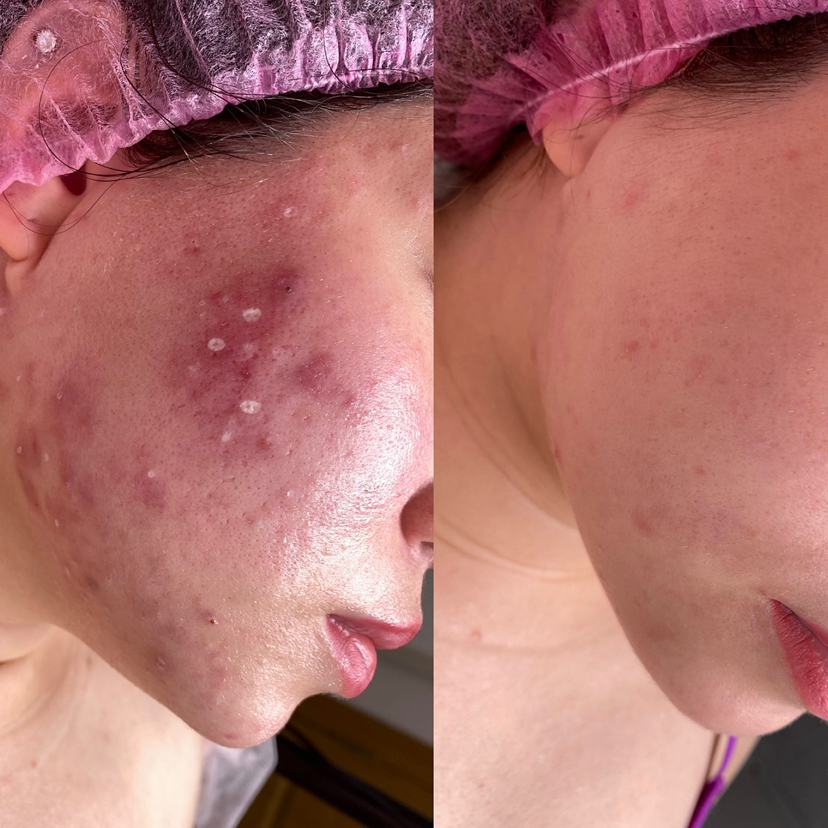 Консультация при акне