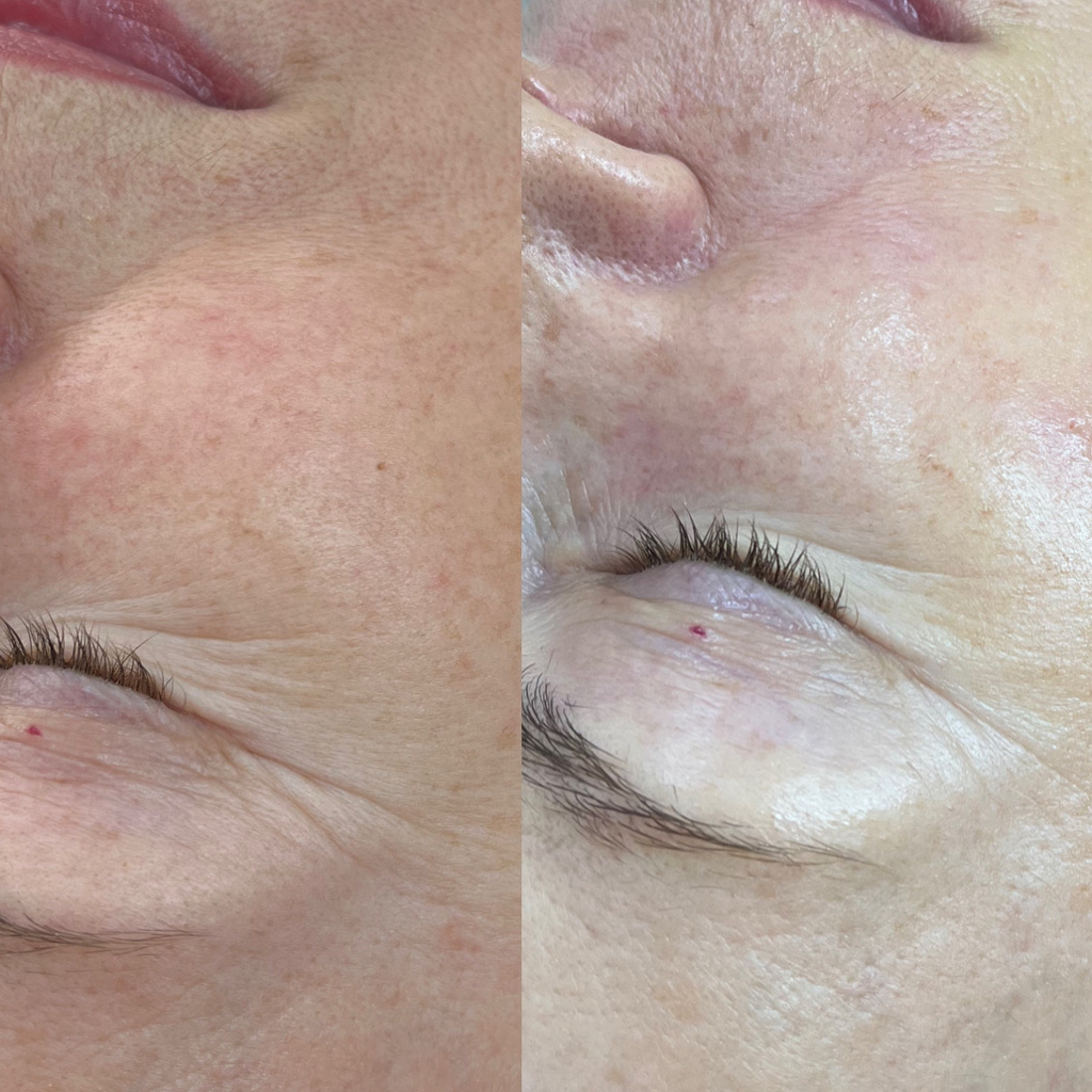 Пилинг при возрастных изменениях pHformula (Испания)