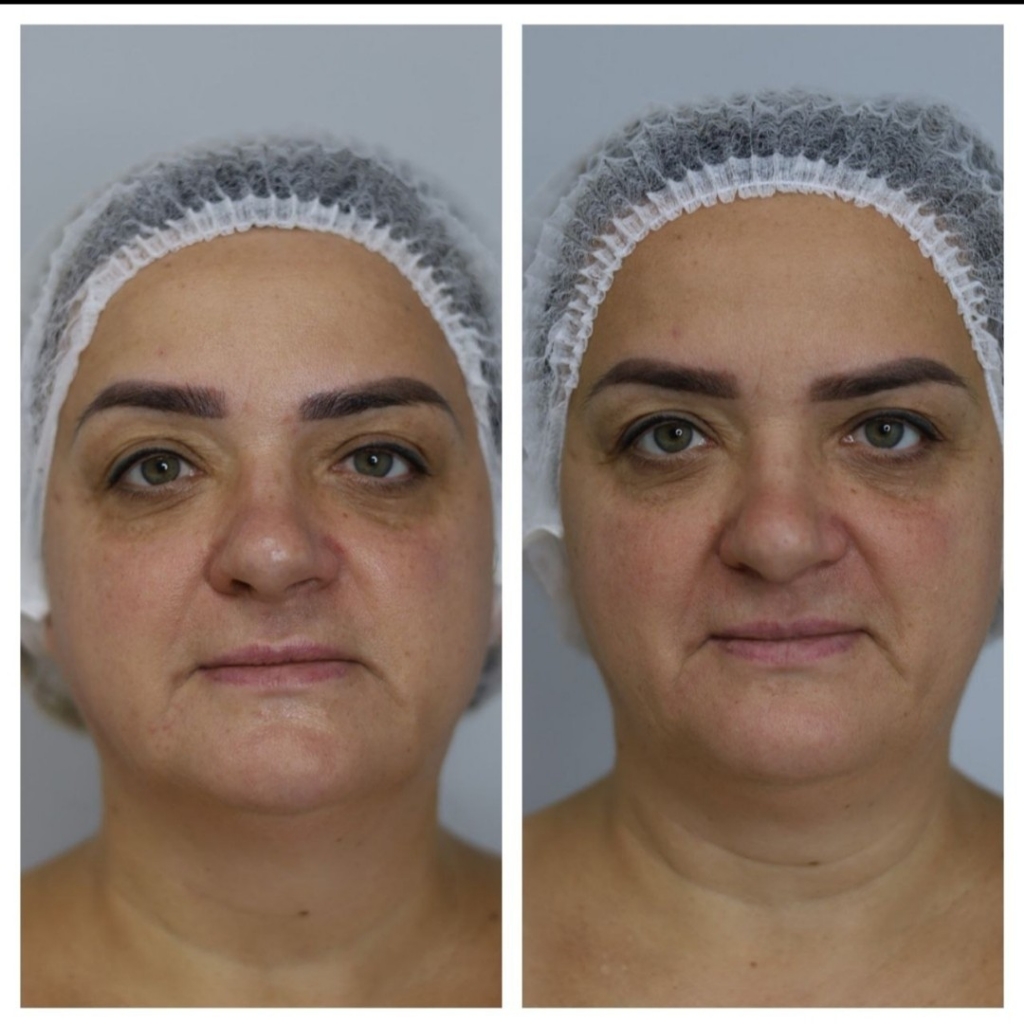 Лифтинг массаж лица