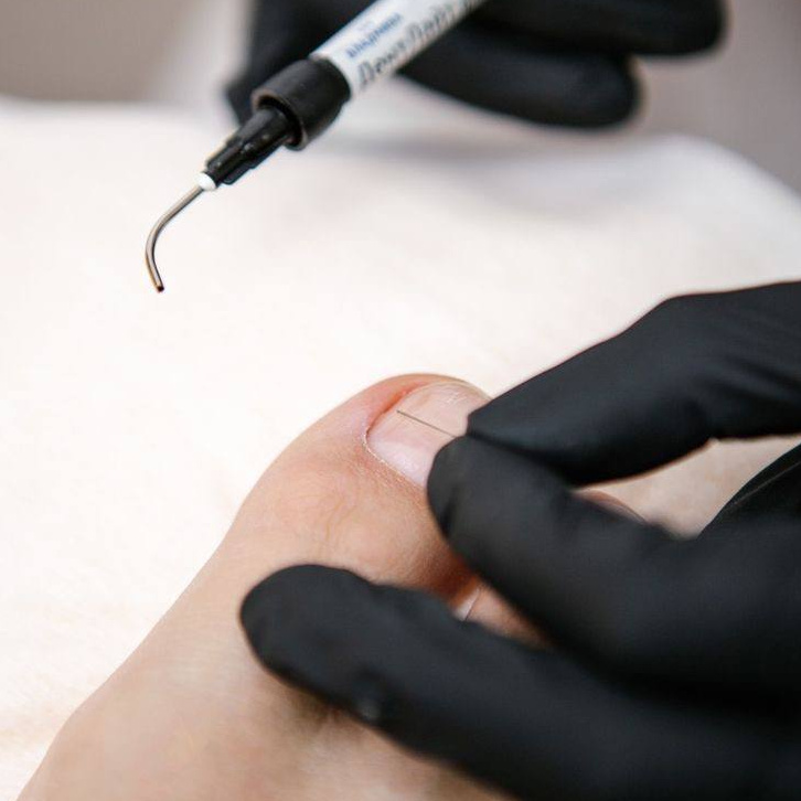 Коррекция крючковых систем ЗТО/ORA/Фрезера