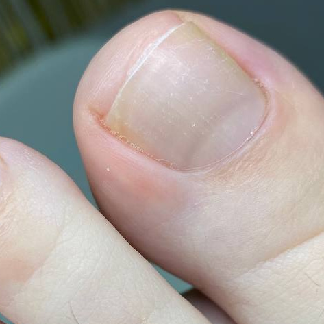 Повторная обработка вросшего ногтя