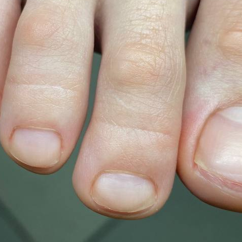 Обработка папилломы