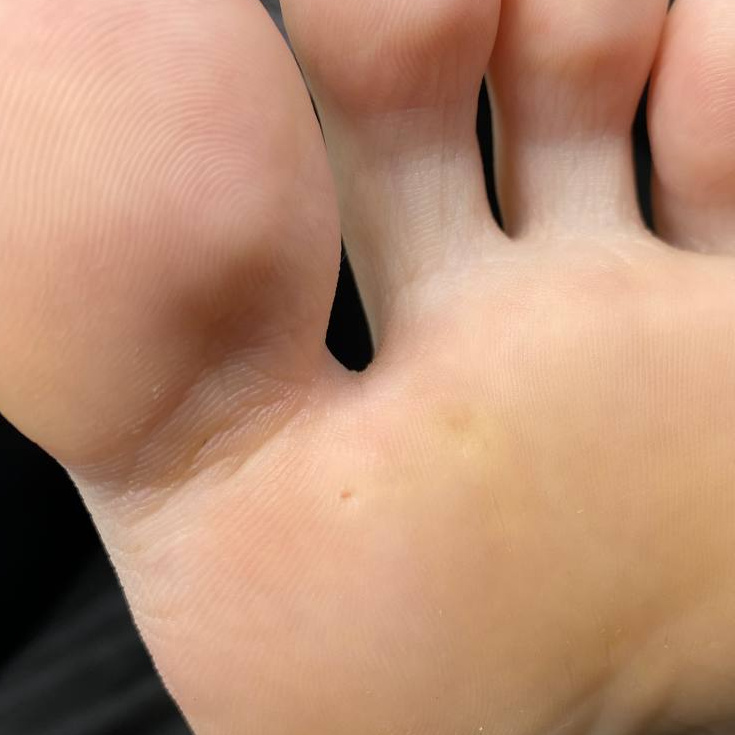 Обработка стержневой мозоли