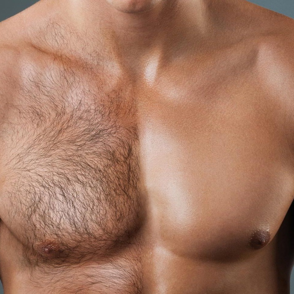 Мужская Электроэпиляция