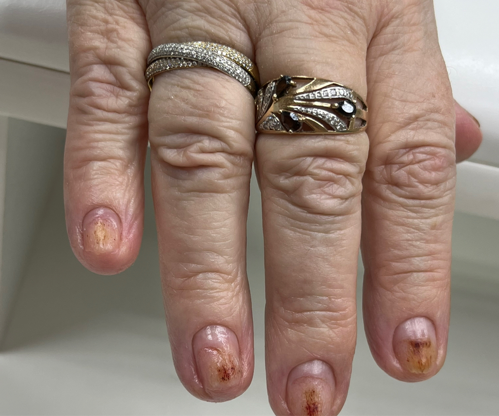 Маникюр медицинский