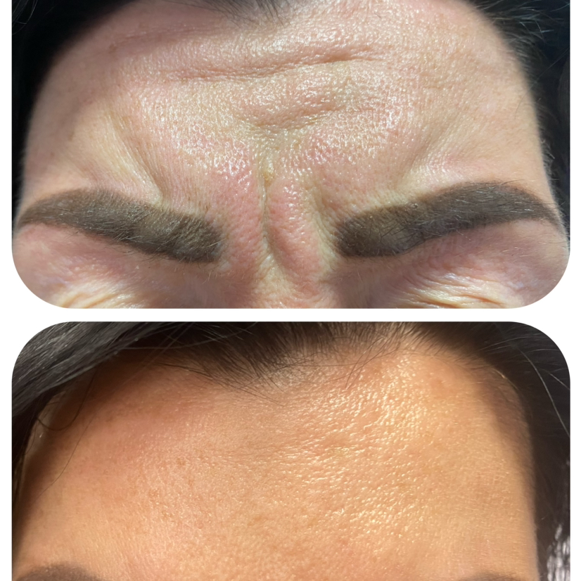 БТА Межбровье