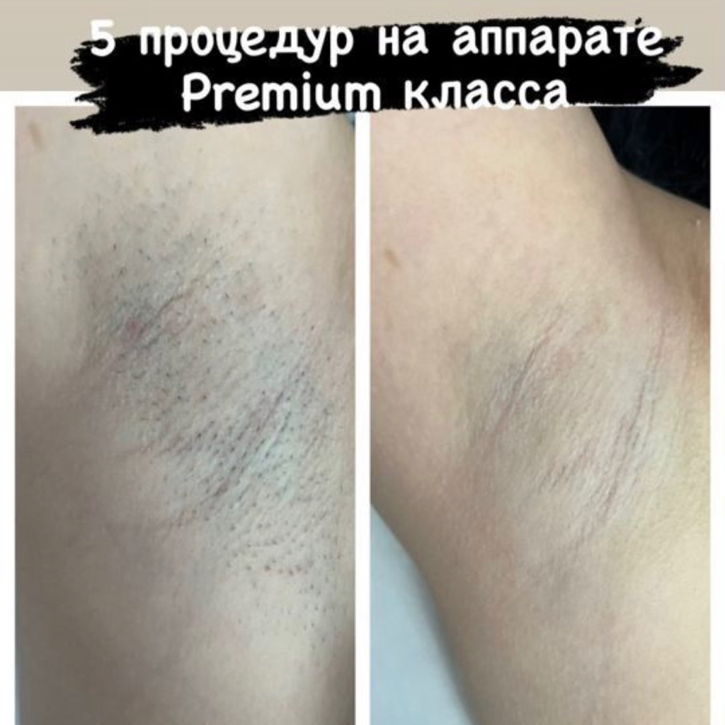 Комплекс лазерной эпиляции глубокое бикини+подмышки+Голени с коленом