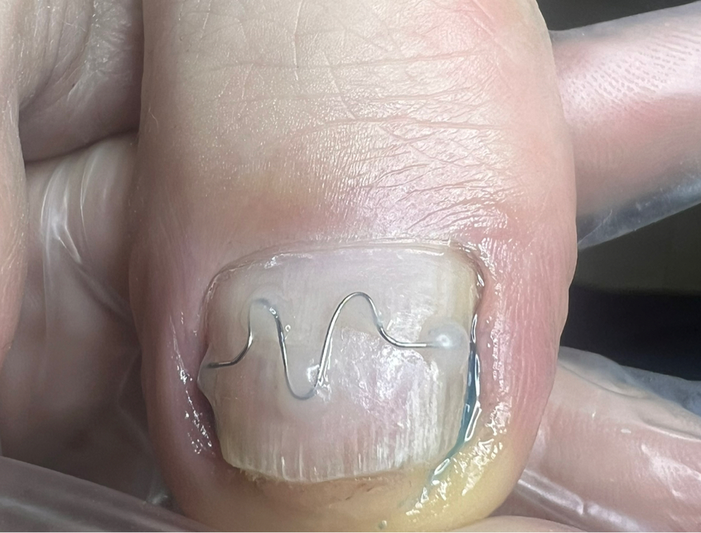 Коррекция скобы «Unibrace»