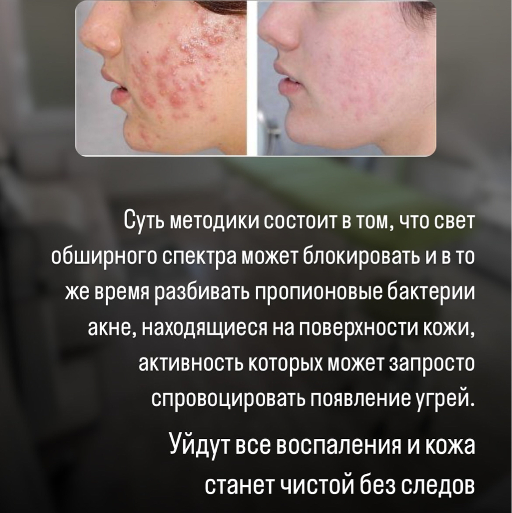 Элос лечение акне