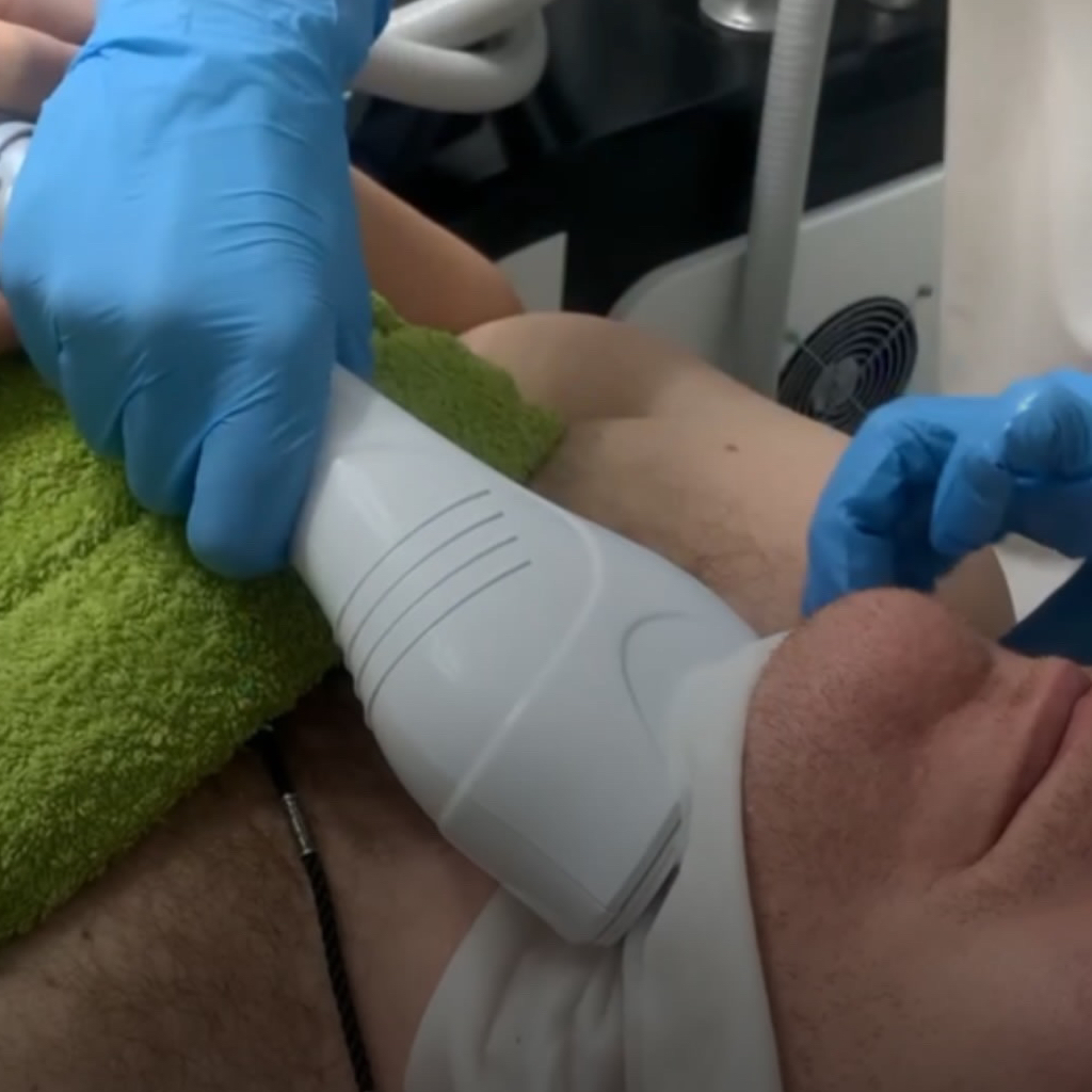 Криолиполиз подбородок