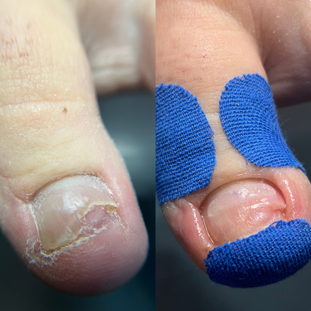 КОРРЕКЦИОННАЯ СИСТЕМА ДЛЯ НОГТЕЙ  « LIGHT SYSTEM »