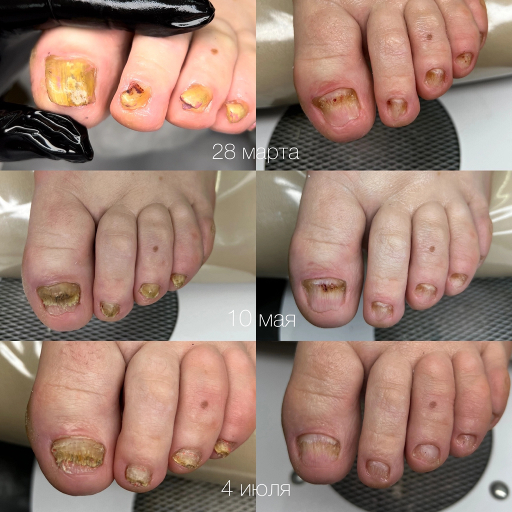 ПОДОЛОГИЧЕСКИЙ ПЕДИКЮР (Обработка ногтей)