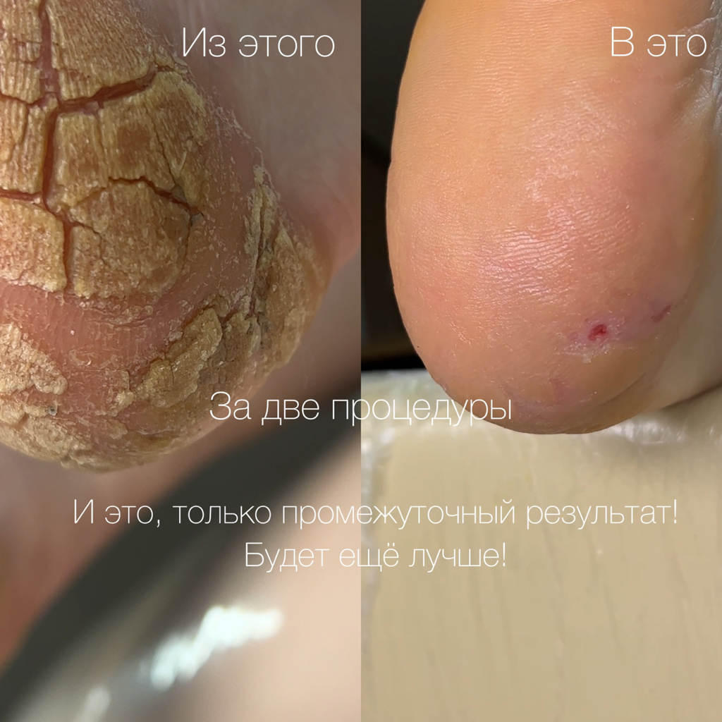 ПОДОЛОГИЧЕСКИЙ ПЕДИКЮР (Обработка стоп)