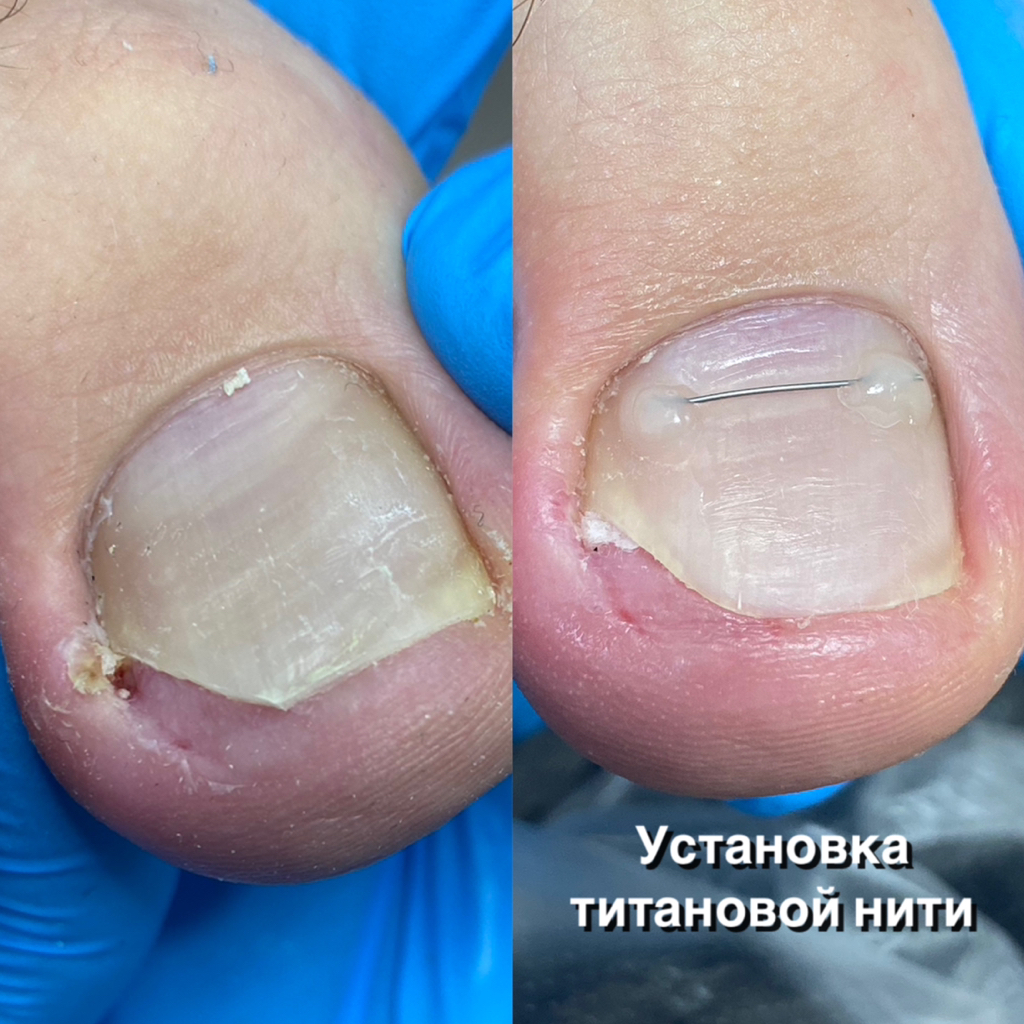 Установка титановой нити