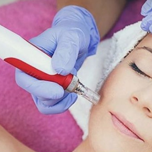 Микроигольчатая стимуляция (лицо) (Микронидлинг)