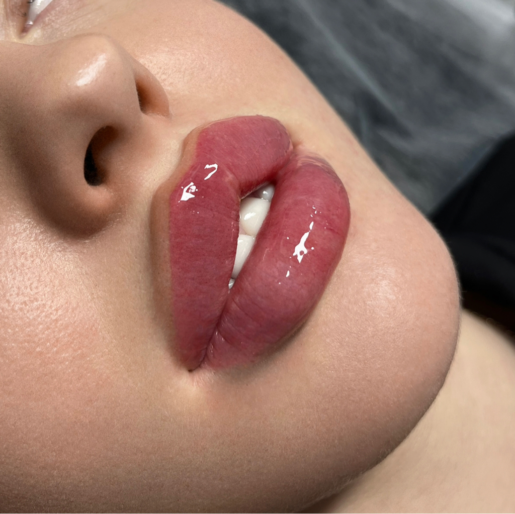 Увеличение губ