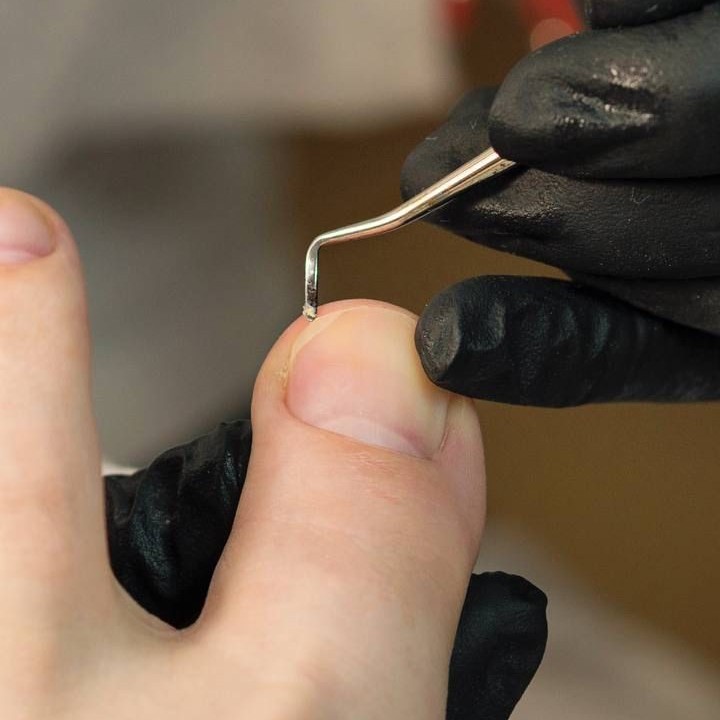 Вросшие ногти (удаление),Педикюр SMART Аппаратный  Удаление вросших ногтей