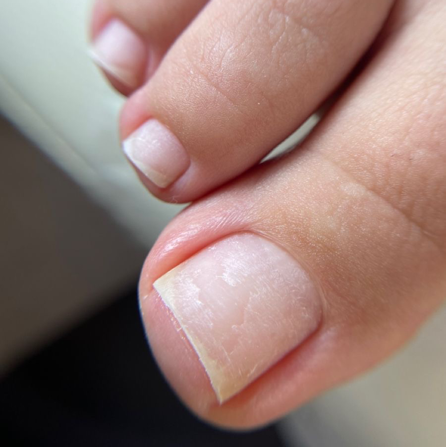 Pedicura higiénica
