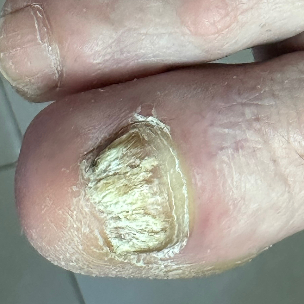 Обработка одного ногтя с онихомикозом (грибок) + санация ногтевого ложа