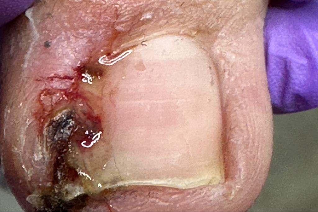 Обработка вросшего ногтя