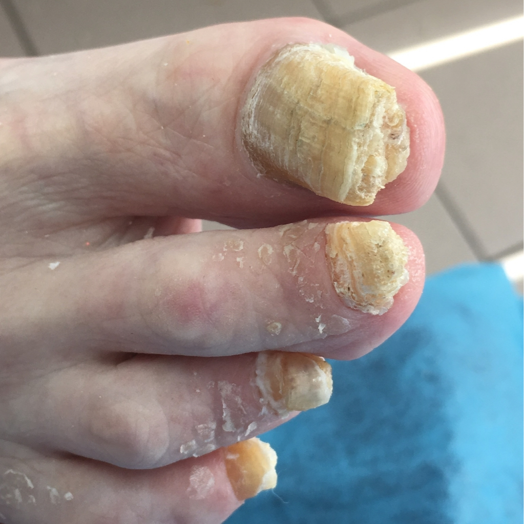 Аппаратная обработка при онихомикозе (грибок) 5 и более ногтей