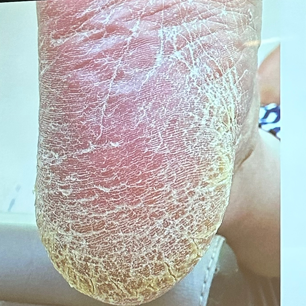 Обработка стопы с дерматомикозом (грибок)