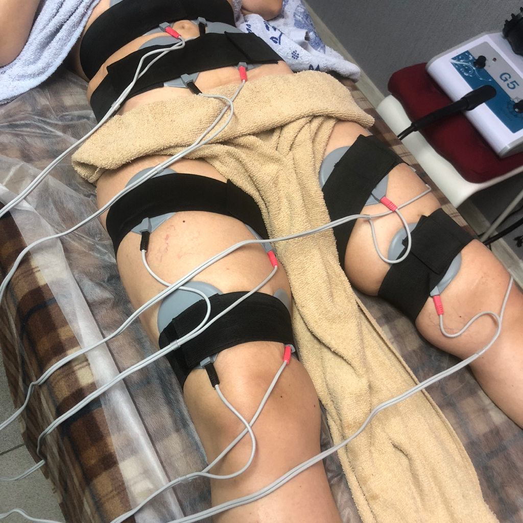 Миостимуляция