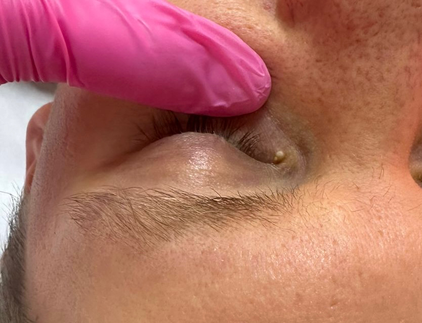 Удаление миллиума