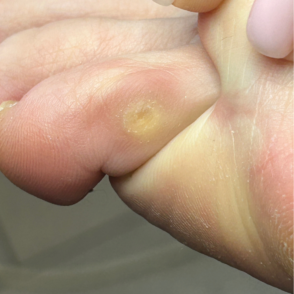 Стержневая мозоль с разгрузкой