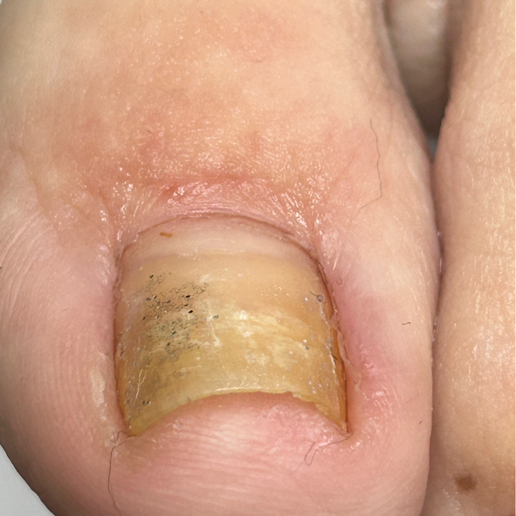 Зачистка 1 ногтя.  Онихолизис(пустоты под ногтем )