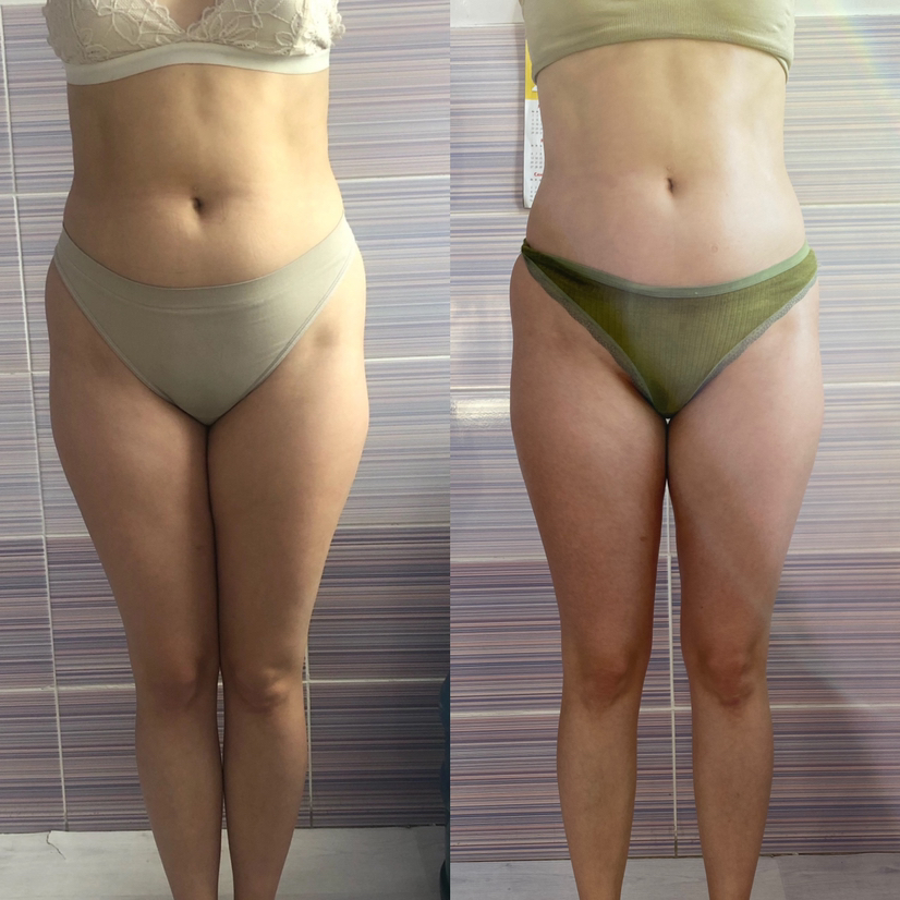 Проблемные зоны Зоны на выбор: Ноги полностью/ Ноги полностью + живот/ Живот, бока, спина