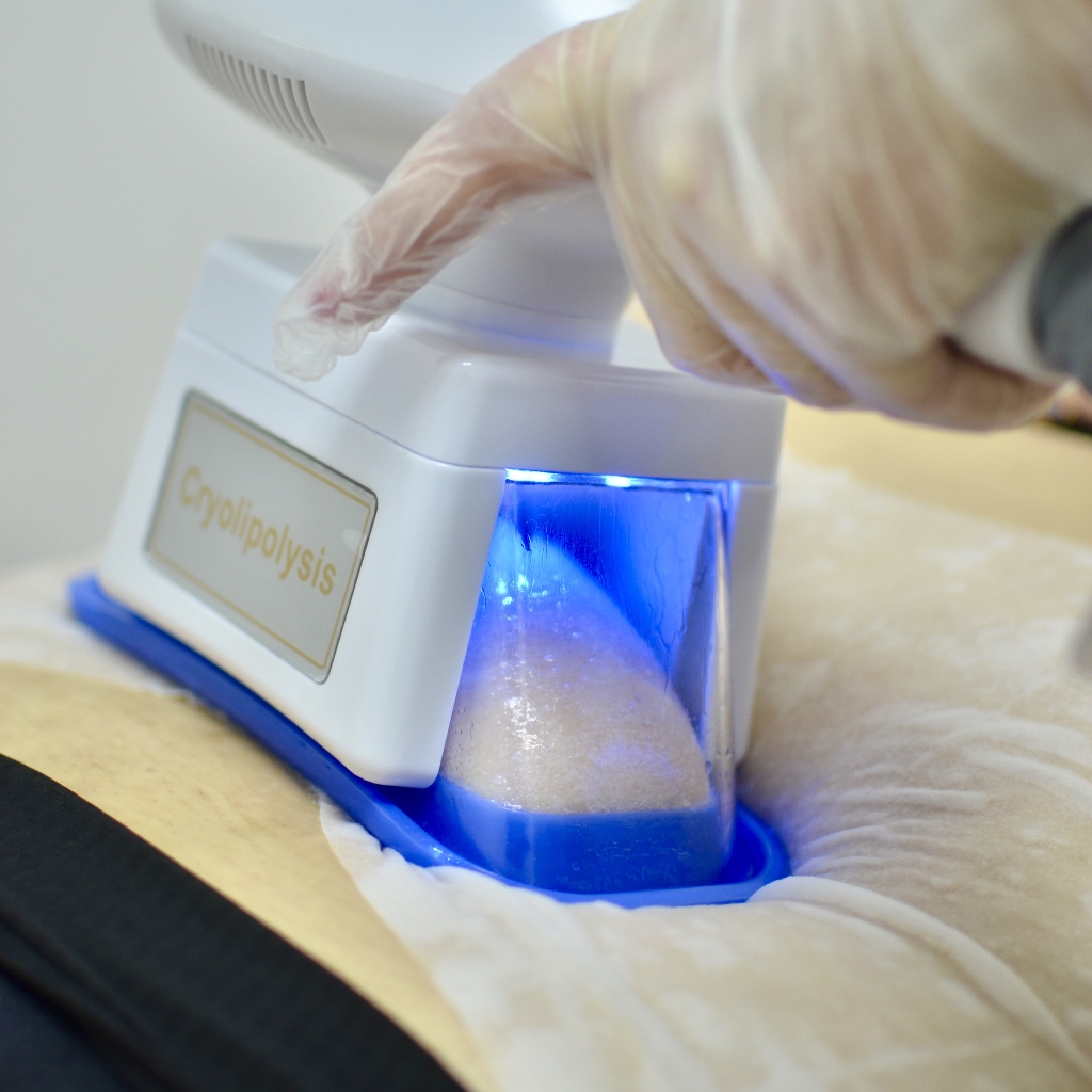 Криолиполиз