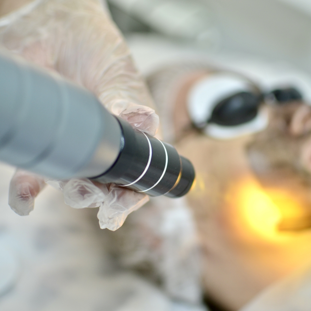 Карбоновый пилинг