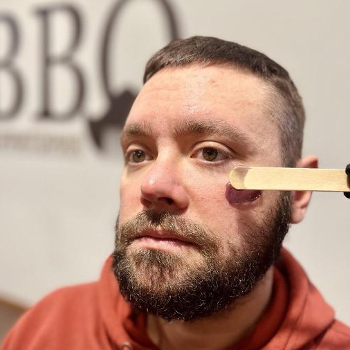 Ваксинг (удаление воском) щеки