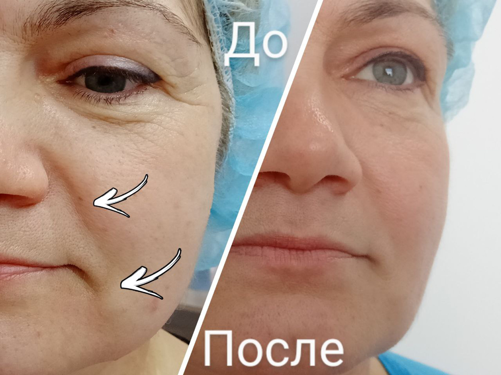 Смас лифтинг лицо + подбородок