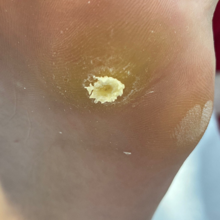 Медицинский педикюр