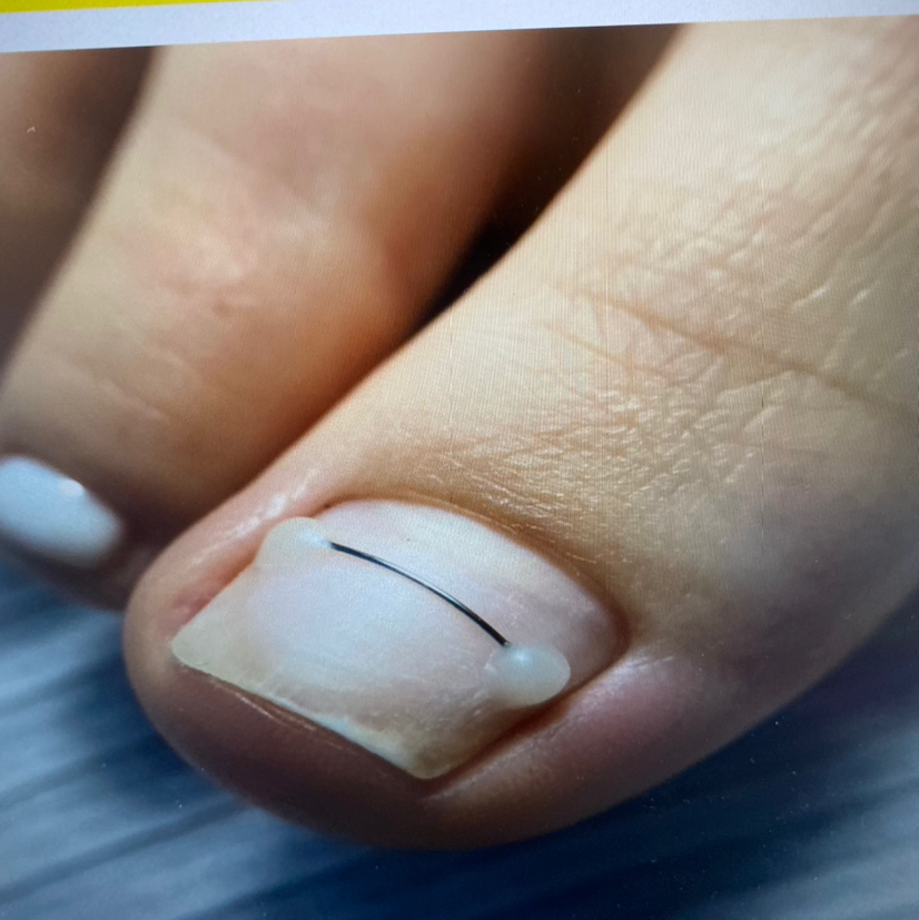 Установка титановой нити