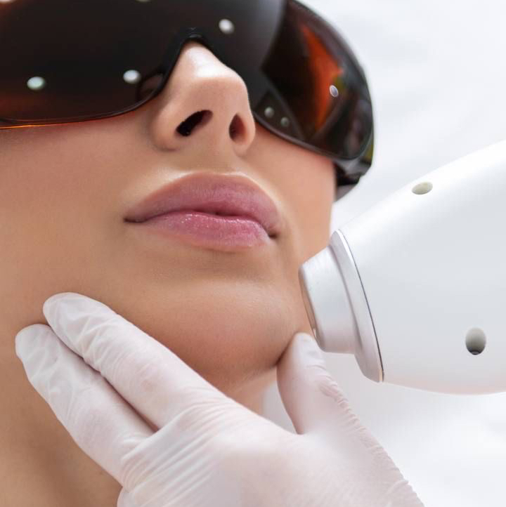 ЛЭ лицо одна зона Усики/ Подбородок/ Щеки