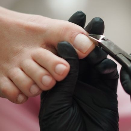 Удаление только вросших ногтей